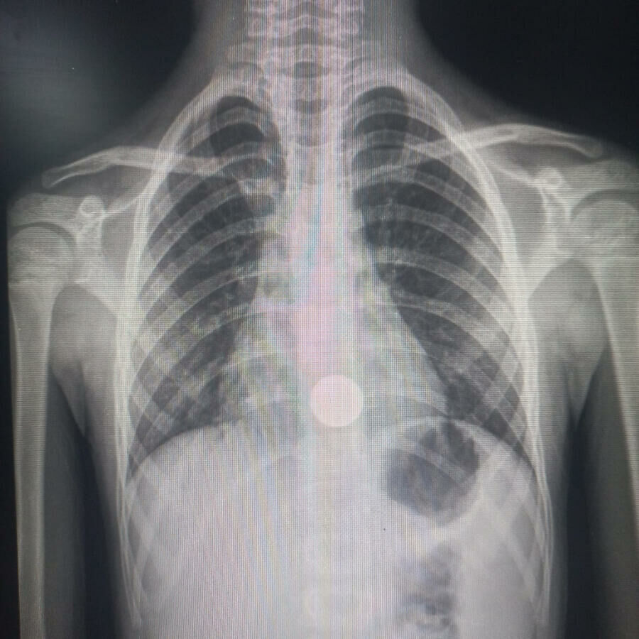 Imagem de compartilhamento para o artigo Criança de 7 anos engole moeda em Paraíso das Águas e passa por cirurgia na Capital da MS Todo dia